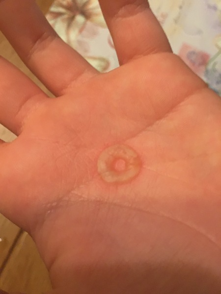 Anybody know what this mysterious blister could be?