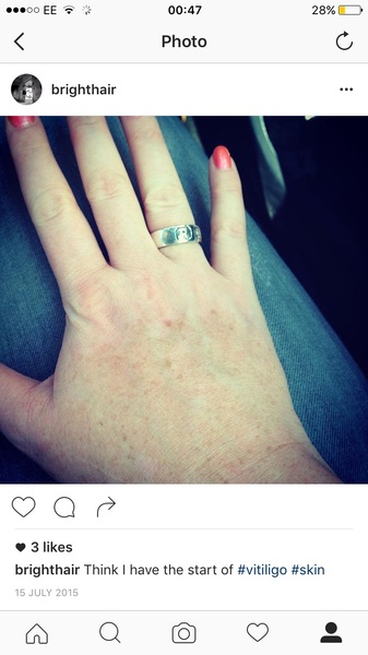 Vitiligo? Or just normal scab behaviour. Terrified.