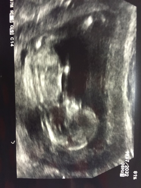 April 2017 #4 More baby scans, less morning sickness!