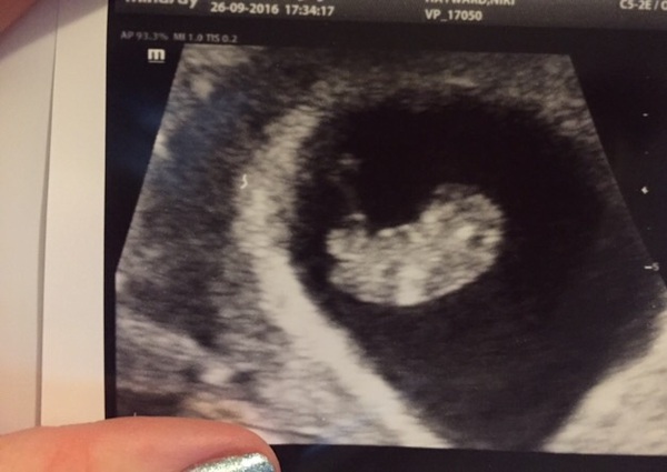 May 2017 Thread #2 - sore boobs, early scans & feeling rather queasy!