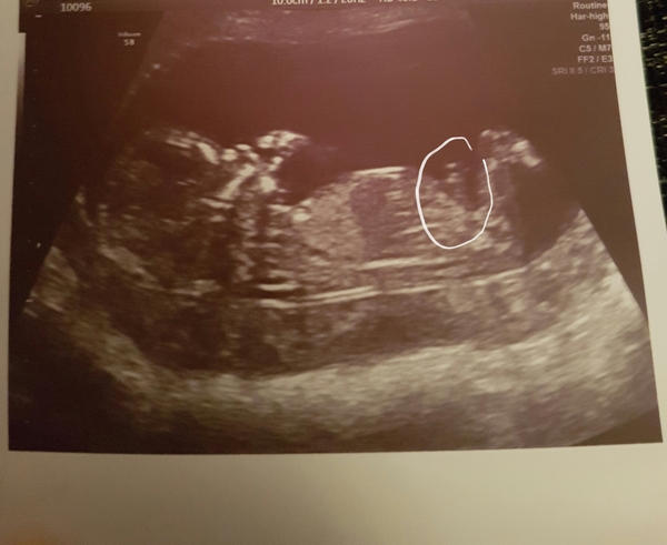 baby gender