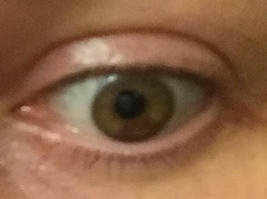 Star shape in son's iris of eye