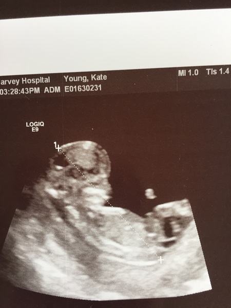 April 2017 #4 More baby scans, less morning sickness!