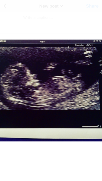 April 2017 #4 More baby scans, less morning sickness!