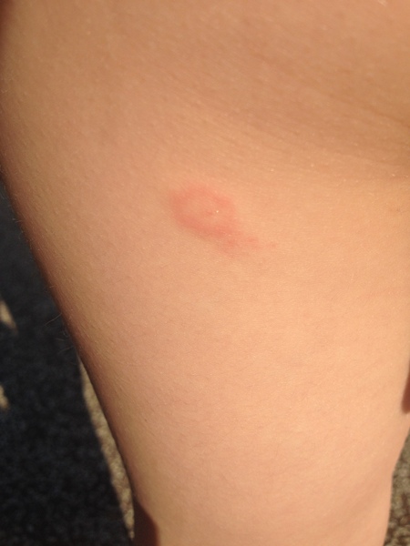 Anyone with tick bite/Lyme disease experience?