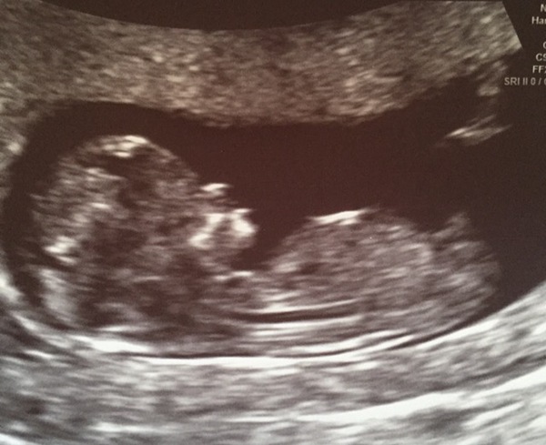 April 2017 #4 More baby scans, less morning sickness!