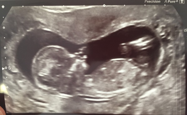 April 2017 #4 More baby scans, less morning sickness!