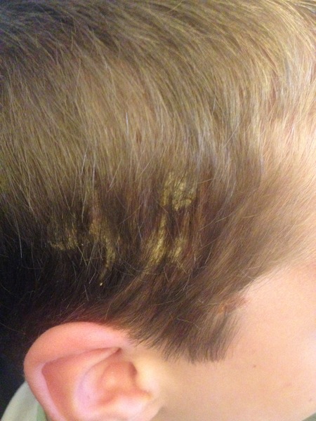 Does anyone know what this is on my sons head?