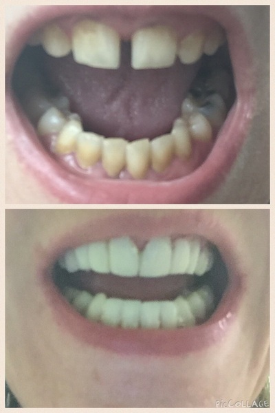 Cosmetic dental treatment