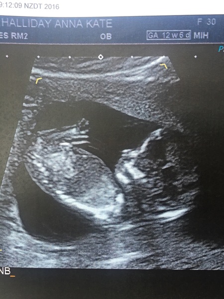 April 2017 #4 More baby scans, less morning sickness!