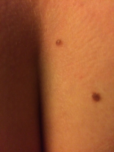 Does this mole look dodgy to you?
