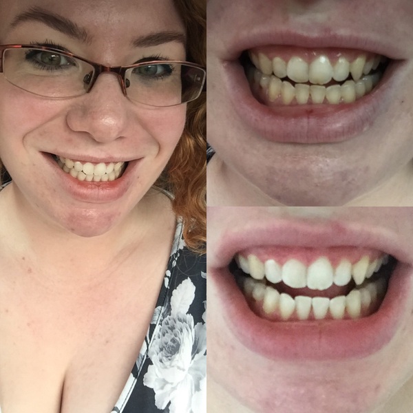 just had my teeth whitened