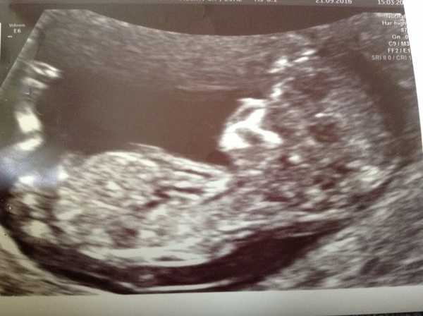 April 2017 #4 More baby scans, less morning sickness!