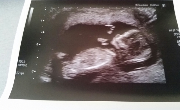 April 2017 #3 - looking forward to first scans and the second trimester!