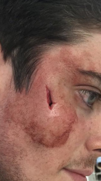 Would you go and visit your son, in uni, if they needed stitches?