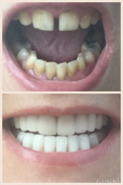 Cosmetic dental treatment