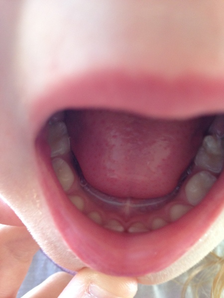 Tongue tie woes and the NHS