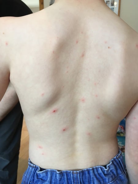 Skin rash