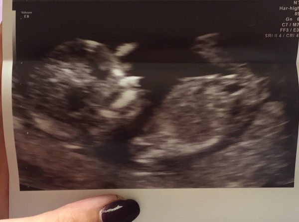 April 2017 #4 More baby scans, less morning sickness!