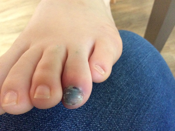 Query Toe Fracture