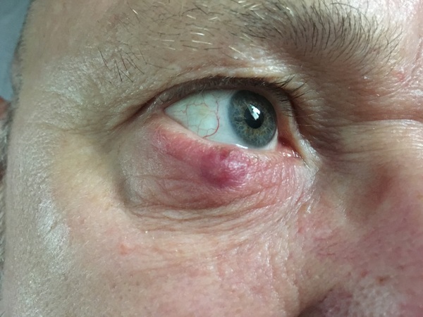KLAXON very angry stye