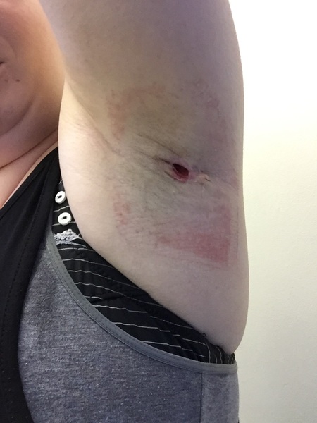 underarm abscess