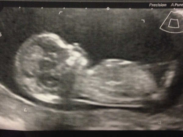 April 2017 #4 More baby scans, less morning sickness!