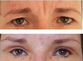My Eye Surgery - Before and After