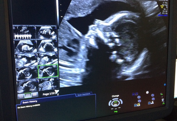 Due February 2017 - Thread 8!