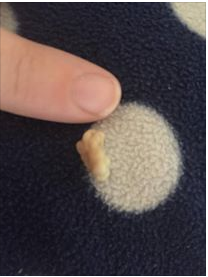 Who loves tonsil stones