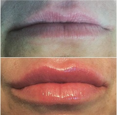 Lip Fillers