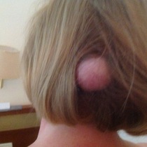 Cyst on head - warning photo attached....