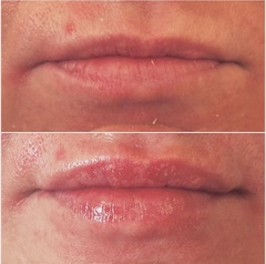 Lip Fillers