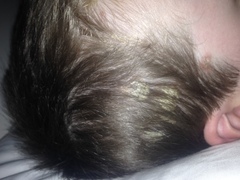 Does anyone know what this is on my sons head?
