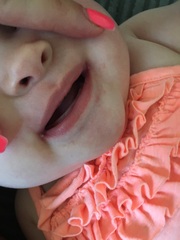Sores at sides of baby mouth