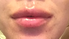 Lip Fillers