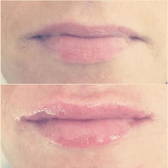 Lip Fillers