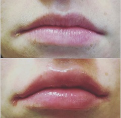 Lip Fillers
