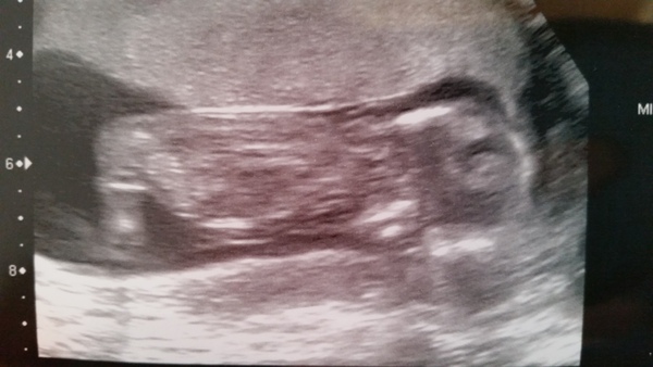 April 2017 #4 More baby scans, less morning sickness!