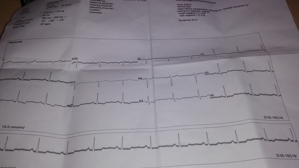 Borderline ECG