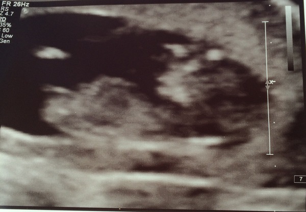 April 2017 #4 More baby scans, less morning sickness!