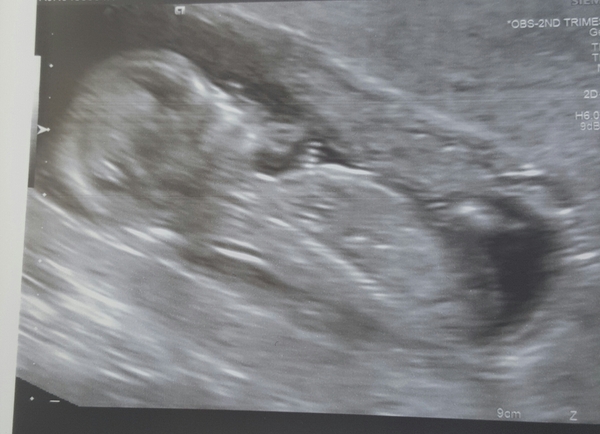 TTC through Donor IUI or Donor IVF or just undecided - all welcome! #makeithappen