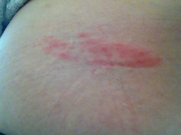 Help! Skin condition or insect bites?!