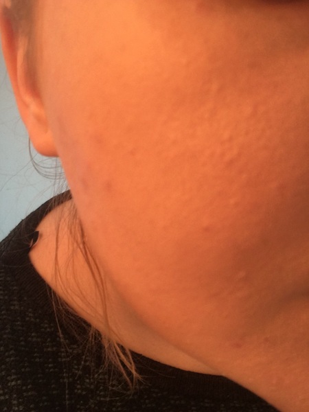 Little bumps on my cheeks