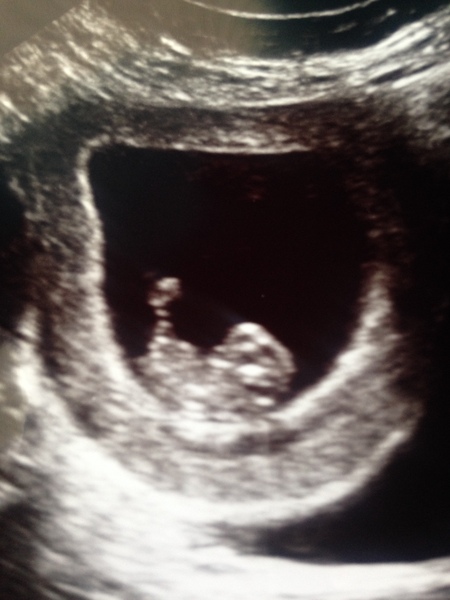 May 2017 Thread #2 - sore boobs, early scans & feeling rather queasy!