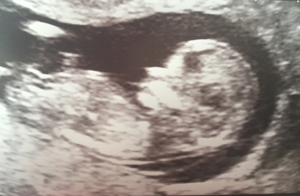 April 2017 #4 More baby scans, less morning sickness!