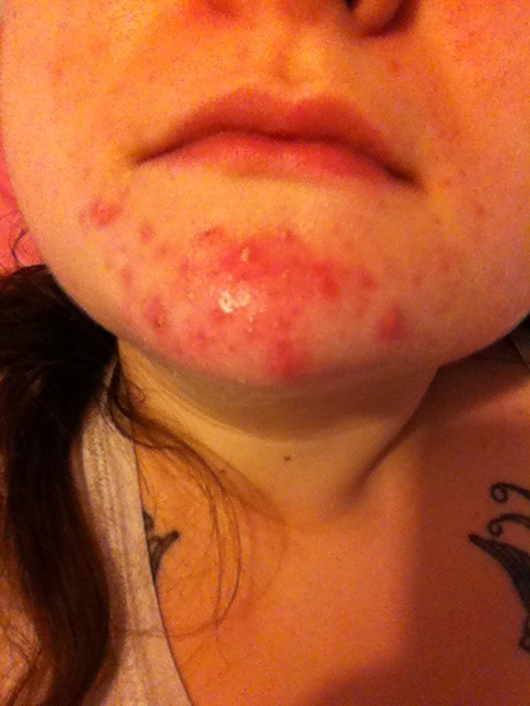 Roaccutane