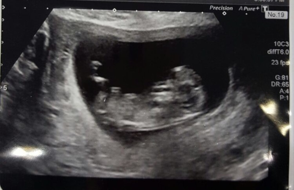 May 2017 Thread #2 - sore boobs, early scans & feeling rather queasy!