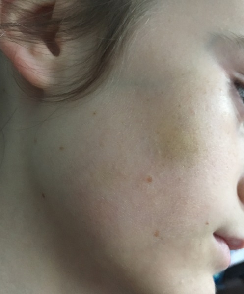 Ds has been punched in the face twice at school.