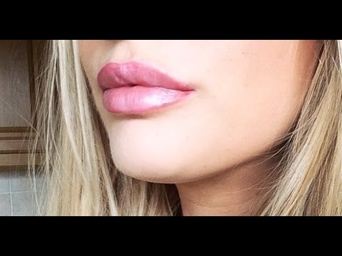 Lip Fillers